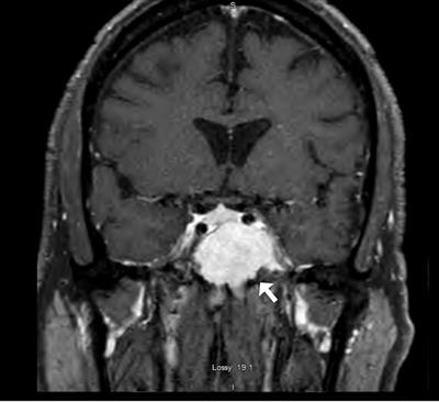 Case Report: Cavernous Sinus Syndrome as the Initial Presentation of Multiple Myeloma
